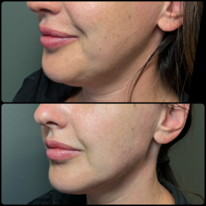 Before and after: jawline. Portland, Oregon.