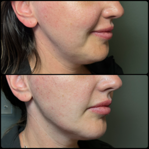 Before and after: Juvéderm Voluma and Volux in the cheeks, jawline and chin. Portland, Oregon.
